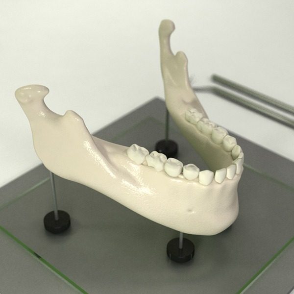 Impression d'une mâchoire en 3D